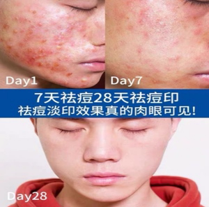 祛痘膏修复祛炎消痘印红肿下巴痤疮收缩毛孔粗大粉刺闭口草本祛痘