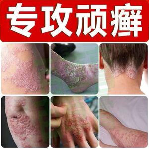 云南百草牛皮癣牛皮癣特效药膏印度神经性皮炎神奇毒癣王癣螨双克