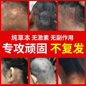 毛襄炎专用药乳膏去根瘙痒外用头湿疹专治止痒头藓喷雾头皮痒特效