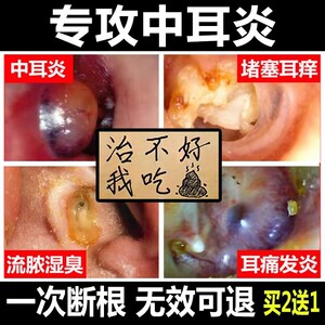 中耳消炎滴耳液流脓人用耳膜炎流水真菌感染烂痒痛闷堵穿孔非药膏