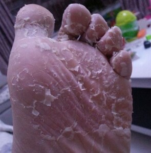 脚底板手掌心大痒杀菌脚底起皮脚臭汗开裂抗真脱皮药水泡型烂脚丫