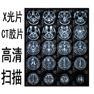 ct胶片扫描 x光片扫描 医用胶片扫描
