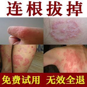 00郑家女儿淘宝牛皮癣专用药膏银屑病外用软膏头部藓的皮肤病特效