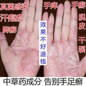 手蜕皮的药膏足藓抗真菌感染手脱皮干裂水泡汗疱疹湿疹止痒治头癣