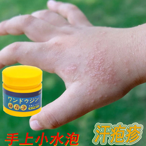 汗疱疹鹅掌风手痒脱皮止痒汗孢疹专用治疗手上起小水泡手足癣药膏