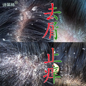 头皮癣药膏头部真菌感染去头屑头癣毛囊炎银屑藓抑菌专用洗发水
