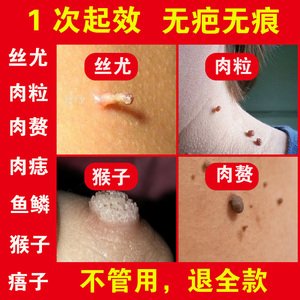 祛刺瘊子皮赘去除膏去猴子脖子上长小肉粒疙瘩神器痦子药肉瘤凸痣