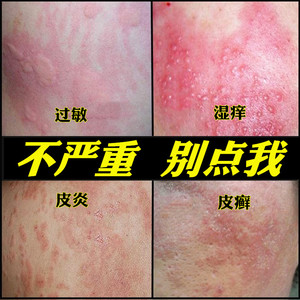 皮肤干燥全身痒脚丫痒真菌细菌感染癣痒克星皮毒清一抹灵特效乳膏