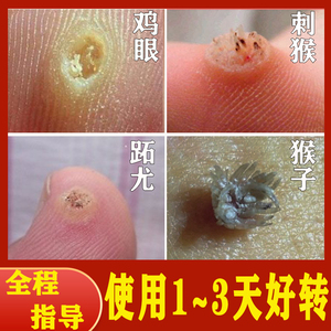 00熊彬168淘宝疣候平点去猴子的药肉粒疙瘩祛休子瘊子去除神器鱼鳞