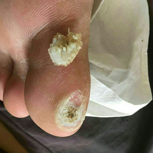 药膏 瘊子刺药膏 跖疣膏 手脚肉刺 祛甲周疣老茧脚垫 死皮脚