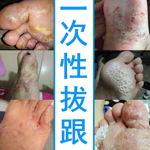 治疗脚气脚痒脱皮杀菌水泡型去根神器药膏止痒真菌感染根治香港脚