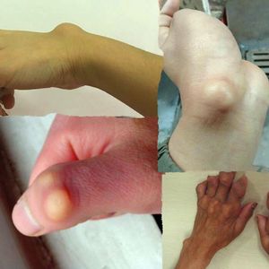 腱鞘舒筋贴大拇指关节鼓包手腕键鞘囊肿手指专用膏贴健鞘炎痛舒贴