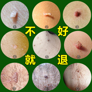 丝状疣去除颈部小肉瘤肉猴子特傚治肉瘊子药膏脖子腋下肉粒老鼠痣
