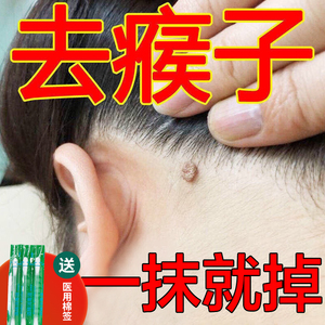祛瘊子皮赘药猴子脖子上长小肉粒疙瘩腋下痦子去除神器赘药肉痣
