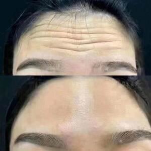 新品国货医朵水凝胶额头贴抬头纹川字纹修复去除提拉紧致面膜男女