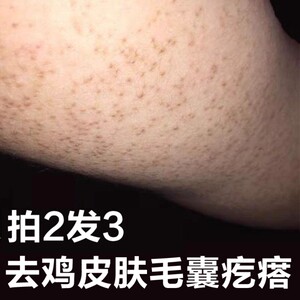 去鸡皮肤疙瘩毛囊角化毛周鸡皮肤救星去除神器小腿手臂上的疙瘩