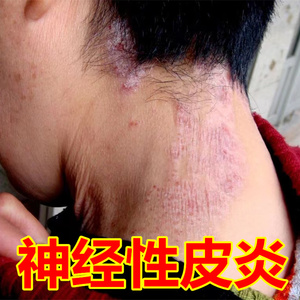 李氏百草膏治疗神经性皮炎去根除外用专治止痒皮肤瘙痒药膏日光性