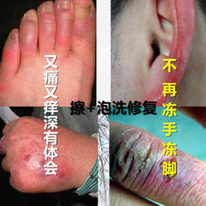 000人付款天猫佰草世家冻疮药膏消肿止痒防冻裂冻伤手脚耳脸部护手霜