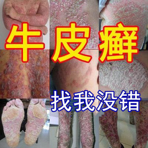牛皮止痒皮肤外用药专用治疗过敏抑菌瘙痒顽固癣藓银屑病湿疹药膏