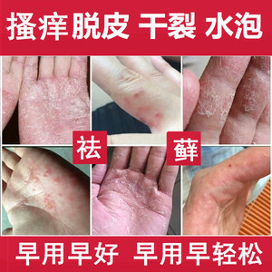 苗医苗方手癣药膏止痒抑菌手痒水泡脱皮干裂真菌感染手足湿疹皮炎