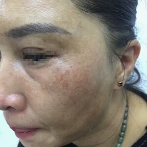 液氮祛斑膜