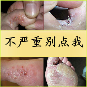 治疗脚气药水去除严重脚气膏臭脚汗糜烂杀菌孕妇止痒脱皮灰指甲癣