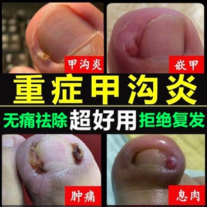 甲沟炎专用药消炎消肿神器治疗疼痛软化灰指甲专用杀菌去肉芽正品