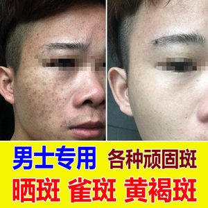 去雀斑男男士祛斑霜