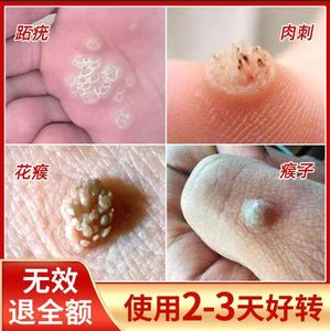 祛刺猴去除正品鱼鳞痣瘊子药手足部位去猴子肉粒疙瘩脚肉刺去除膏