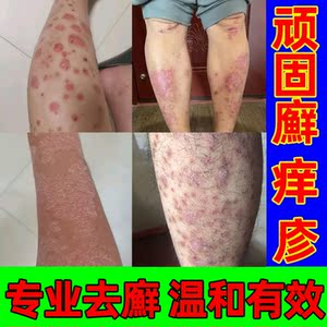 荨麻疹过敏止痒杀菌治疗专用药皮肤病专用药膏中药止痒的药膏苗方