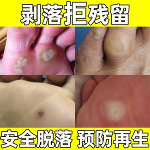 治疗扁平疣的药膏瘊子去老茧脚茧脚长鸡眼尖疣湿锐脚鸡眼湿疣药膏