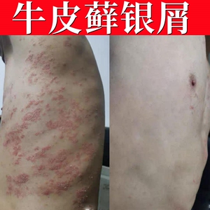 治疗皮肤牛皮癣止痒肛门痒的药膏皮肤过敏湿疹手部日本日光性皮炎
