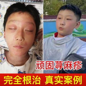 急慢性丘疹性荨麻疹血热风团过敏克星止痒去湿泡澡专用中药包