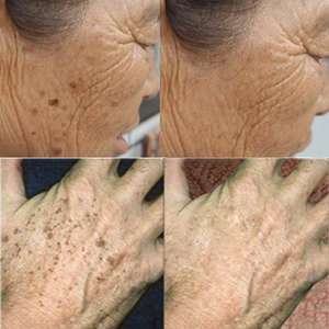 金星推荐祛斑霜专注25-60岁脸部斑手背斑去黑色素 不严重请别点