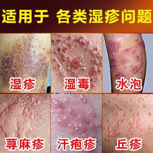 炉甘石药膏湿疹止痒去根外用治疗皮疹热疹顽固慢性皮炎皮癣止痒膏