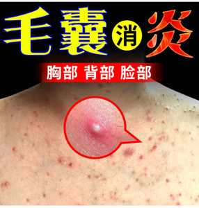毛囊炎根治身体乳专用药膏背上手臂头部后背长痘痘去鸡皮肤特效药