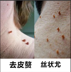 草本去除脖子小肉粒颈小肉球皮赘湿尤肉刺祛丝状尤腋下瘊子鱼鳞痣