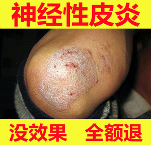 李氏百草膏治疗神经性皮炎去根除外用膏顽固性皮癣皮肤病专用药膏