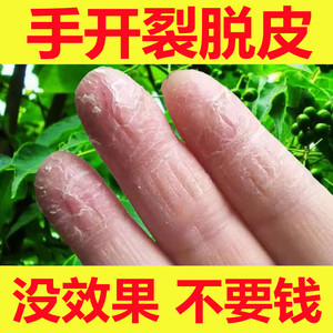 李氏百草治手裂的药膏开裂脱皮治疗的真菌感染鹅掌风脚干裂蜕皮痒