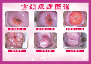 001人付款淘宝宫颈疾病示意图妇科墙贴病变级别海报女性子宫图片美容
