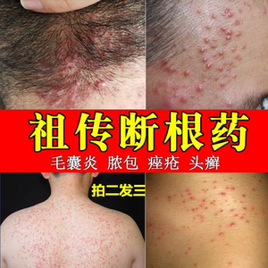 马拉色糠秕孢子菌穿掘性毛囊炎专用药头胸背部痤疮祛痘头皮癣药膏