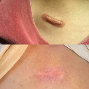 一盒50贴日本增生疤痕凸起疤痕疙瘩蟹足肿