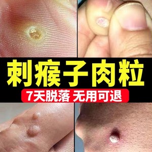 跖疣去瘊子刺猴子肉刺肉粒疙瘩神器足部鸡眼膏贴治疣专用药草本