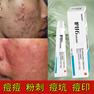 玫瑰痤疮药膏治疗下巴额头青春痘炉甘石止痒湿疹去脸上痘痘的药膏