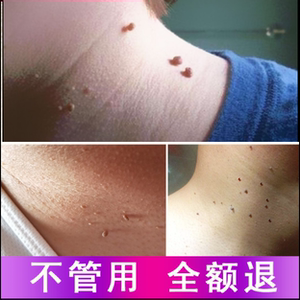 疣液笔5ml尖锐疣平常忧鸡眼肉刺跖疣去忧灵消疣灵疣瘊灵皮赘0人付款