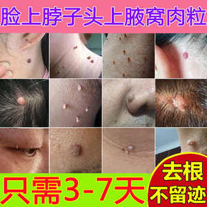 祛肉瘤皮赘去除膏猴子脖子上长的小肉粒疙瘩腋下瘊子凸痣痦子神器