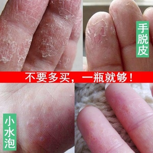 手脱皮的药修复霜