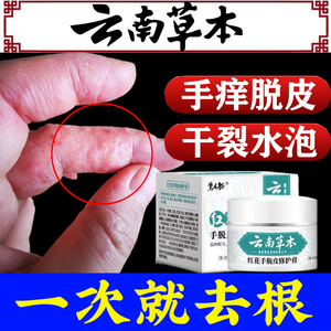 汗疱疹手气膏手廯手足藓真菌感染脱皮干裂水泡蜕皮汗状疱疹药膏