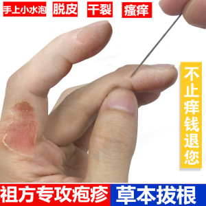 【手足藓药膏真菌感染】手足藓药膏真菌感染品牌,价格 - 阿里巴巴
