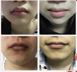 力美吉唇周暗沉嘴唇边黑周围嘴角旁发黑黑色素非神器非去除